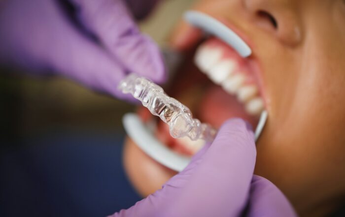 does medi-cal cover invisalign