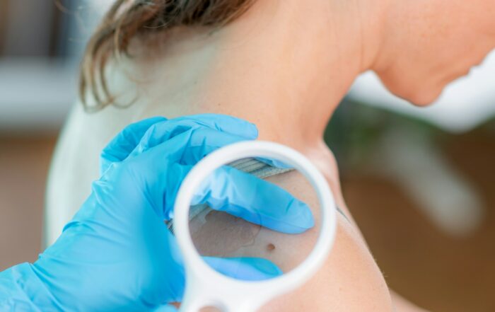 cancerous mole