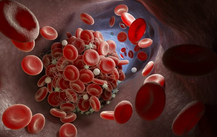 signs of a blood clot