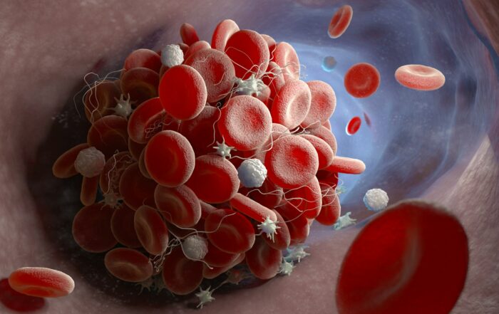 early stage blood clot symptoms