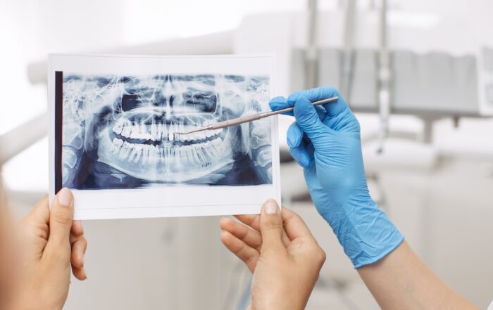 Dental Bridge Cost with Insurance: