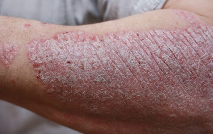 psoriasis symptoms