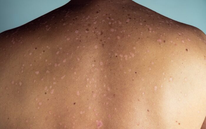 black psoriasis