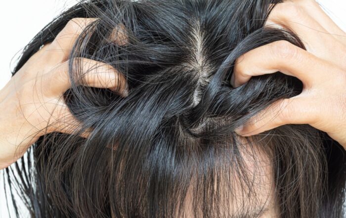 scalp psoriasis vs dandruff