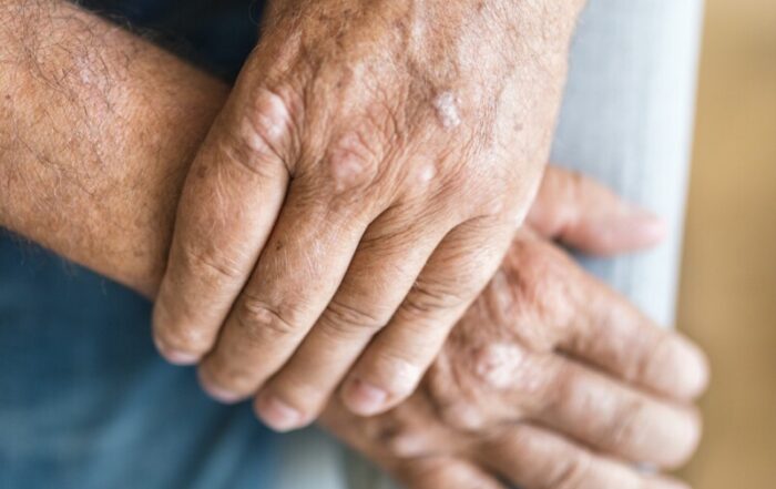 psoriasis treatment