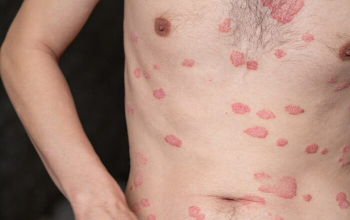 psoriasis