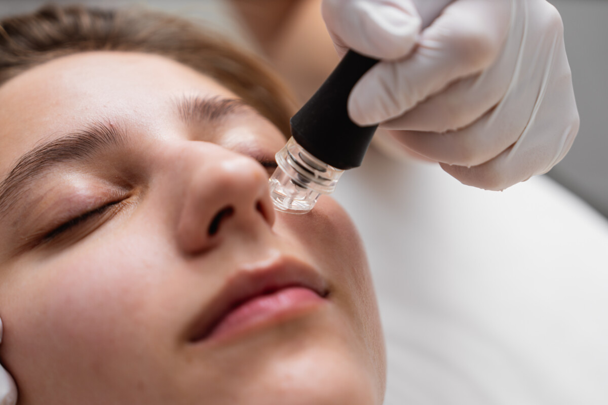 microneedling kansas city cost